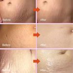 Stretch Marks Fading Cream Maternity Scars Acne Cream Pregnancy Stretch Marks Remove Cream Repair Anti-Aging Winkle Firmng Body Cream (3 PCS) - Image 2