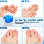 Nail Fungus Laser Treatment Device, Effective and Rechargeable Fungus Remover